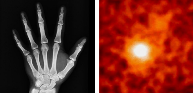 radiografía de una mano y Rayos gamma provenientes de un cuásar